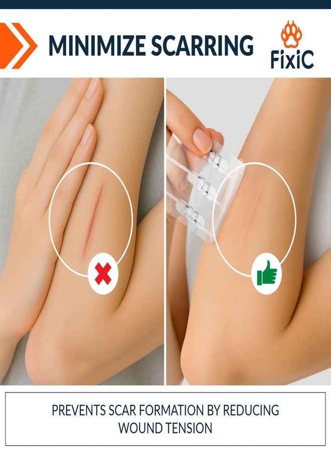 Fixic Butterfly Bandages - 2-Types Zip Wound Closure Strips - Ideal Wound Closure Kit - Sutures Free Butterfly Stitches Bandage - Stitches Kit with 4 Bandages, 4 Pads, and 4 Wipes Included! - Image 4